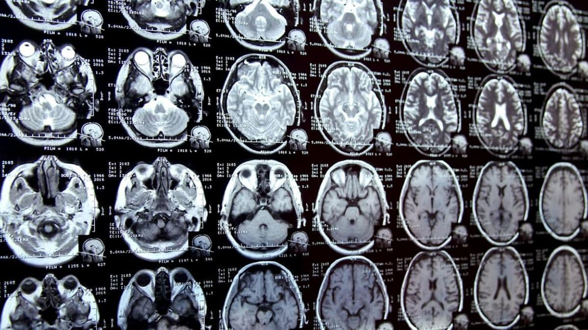 علماء يُطلقون تحذيرًا بعد اكتشاف مقلق: البلاستيك يغزو أدمغة البشر!